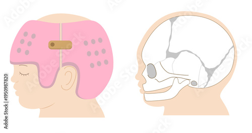 Diagram showing the mechanism of infant cranial correction with helmet therapy