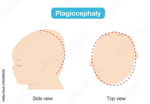 babies with plagiocephaly, brachycephaly, and dolichocephaly showing head shape deformities, top and side view