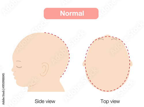 babies with plagiocephaly, brachycephaly, and dolichocephaly showing head shape deformities, top and side view