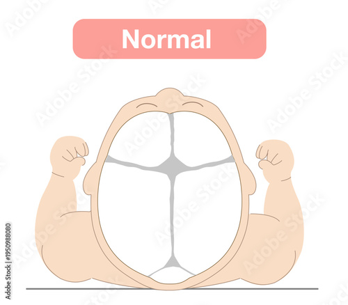 Illustration explaining how sleeping position can cause infant head shape deformities and correct sleeping posture