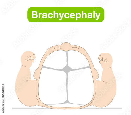 Illustration explaining how sleeping position causes infant head shape deformities such as plagiocephaly, brachycephaly, and dolichocephaly