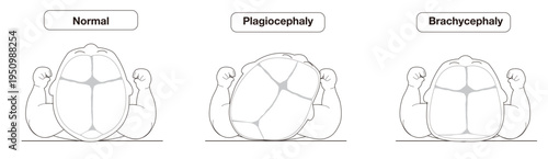 Infant Head Shape Deformities Caused by Sleeping Position – Plagiocephaly, Brachycephaly, and Dolichocephaly Explained