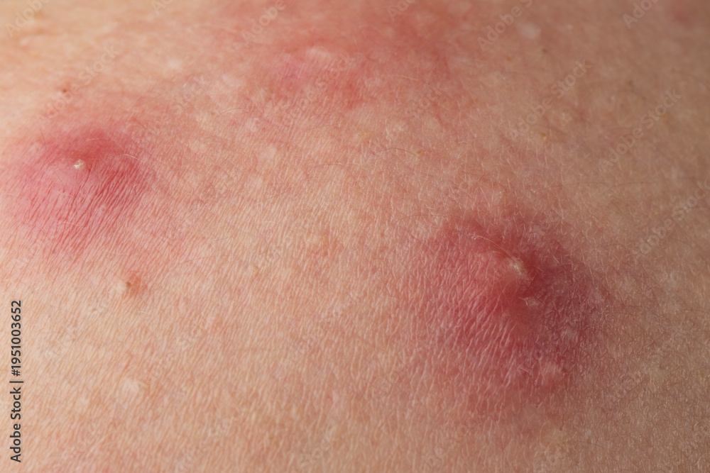 Fototapeta premium Acne on skin closeup photo. Inflamed skin bumps acne macro. Dermatology concept with acne skin pores. Detailed skin with acne.