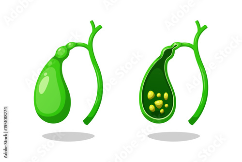 Human gallbladder contains gallstones vector isolated on white background.