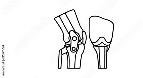 Knee Joint Prosthesis Illustration: Side and Front View of Artificial Knee Replacement