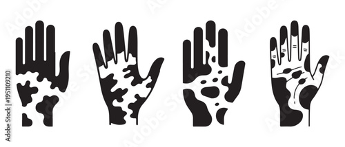 Illustration showing depigmentation patterns on four different hands, representing skin conditions.