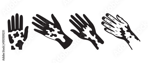Vitiligo skin condition illustrated on hands in progression, line art drawings on white background.