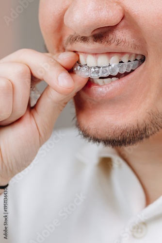 Young man inserting clear dental aligner for straight teeth and at-home orthodontic treatment