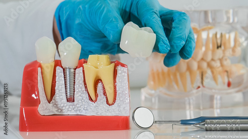 Foto A dentist wearing sterile gloves holds an anatomical model with dental implants