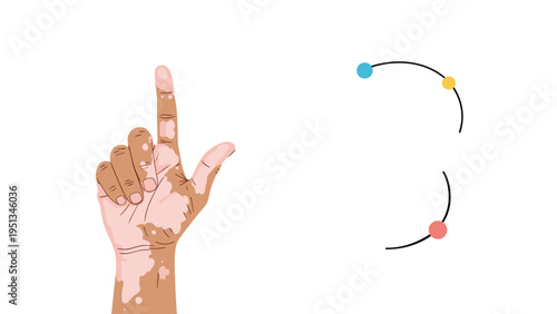 Realistic illustration of a hand with vitiligo skin condition pointing upwards alongside abstract colorful circular elements.