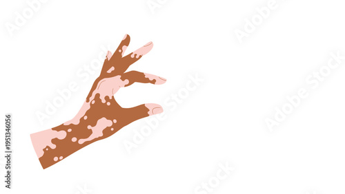 Human hand with vitiligo skin condition making an okay gesture or holding something small isolated on a white background.