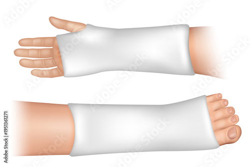 Arm and Leg Plaster Cast Orthopedic Immobilization Medical Illustration. Injury Fixation Medical Concept
