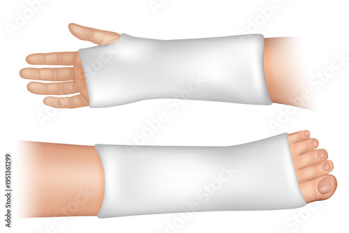 Arm and Leg Plaster Cast Orthopedic Immobilization Medical Illustration. Injury Fixation Medical Concept