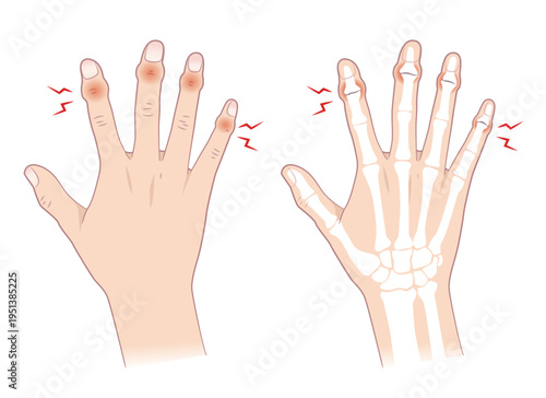 へバーデン結節の症状、右手とその骨