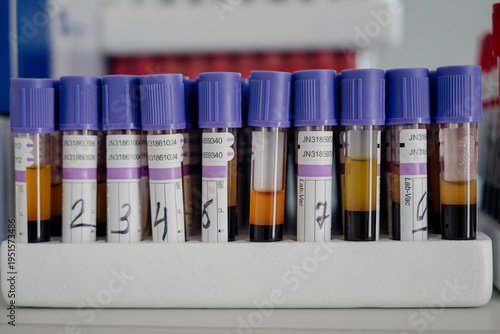 Test tubes with blood samples are ready for laboratory analysis.