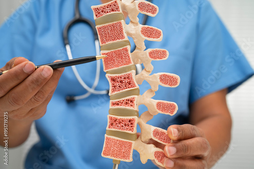 Doctor holding osteoporosis in back bone model for treatment medical in orthopedic department.