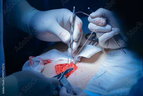 Photos Surgeons performing complex surgical procedure umbilical hernia removal in opera
