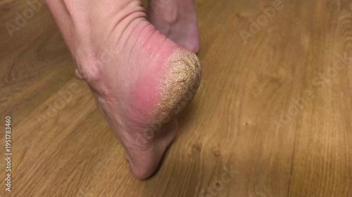 Authentic real life extreme close-up of a dry severely cracked heel on an elderly person foot dermatology healthcare and medical foot care problem real footage no ai