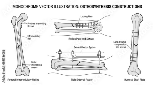 A set of broken bones and limbs secured with metal implantable devices, illustrated with contour lines on a white background; a bundle of osteosynthesis constructions; a monochrome vector