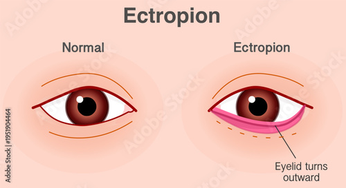 Ectropion is a condition that occurs when your eyelid turns outward away from your eyeball. Irritable, red and sore eyes. Illustration vector