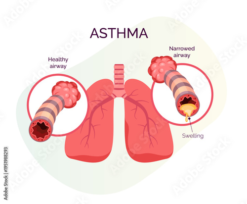 Chronic Inflammation, swelling, and increased mucus production in the bronchial airways - Stock Illustration