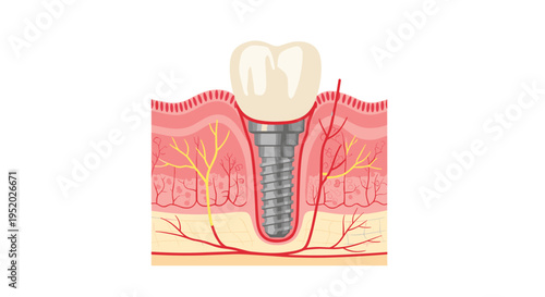 A detailed cross-section diagram illustrates a single dental implant embedded within the gum and bone, showing surrounding nerves and blood vessels.