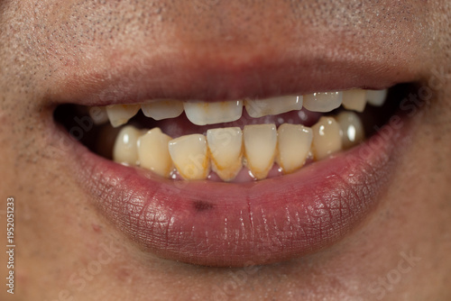 Yellow teeth, gums, and tartar.