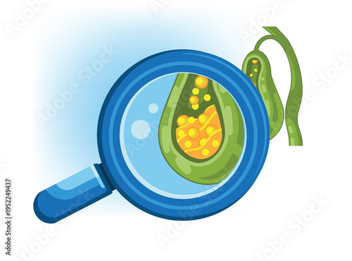 Gallstones in Gallbladder Medical Illustration