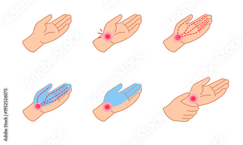 Carpal tunnel syndrome symptoms flat vector illustration of hand numbness and wrist pain