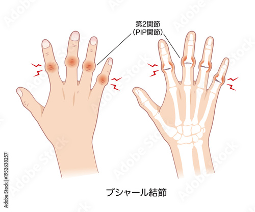 ブシャール結節の症状、右手とその骨