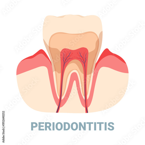Detailed isolated diagram showing periodontitis dental problem and gum inflammation vector illustration