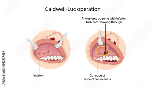 Caldwell-Luc operation
Surgical procedure used to access the maxillary sinus through the canine fossa for treatment of chronic sinus disease or removal of lesions.