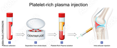 Platelet-rich plasma procedure. Blood сollection, PRP separation from whole blood and Intra-articular injection.
