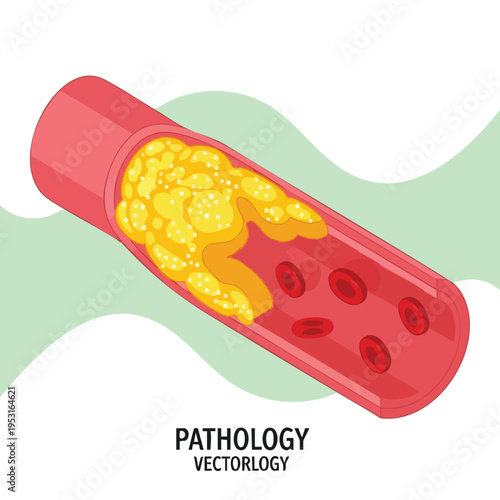 Atherosclerosis. Artery Blockage. Cholesterol Plaque. Blood Vessel. Red Blood Cells. Medical Illustration.