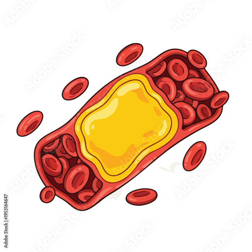Blood Vessel Blockage. Atherosclerosis Plaque. Red Blood Cells Flow.
