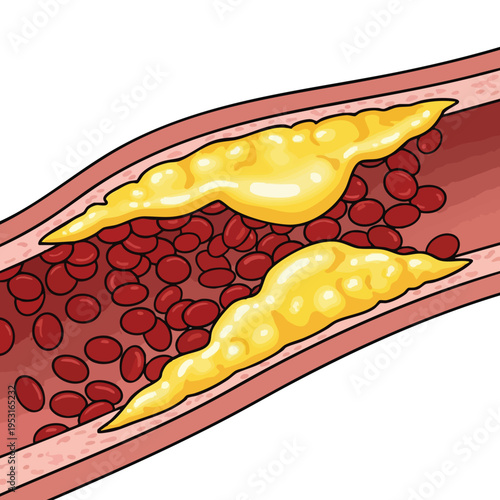 Atherosclerosis: Plaque buildup in artery blocking blood flow