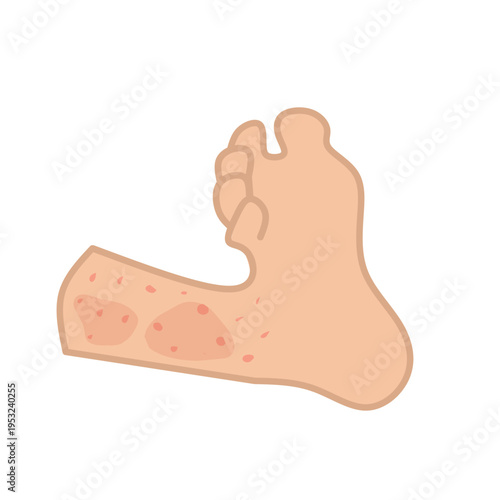 Vector illustration of measles. Body affected by measles. Illustration of hand, feet, face affected by measles. Flat design of measles virus