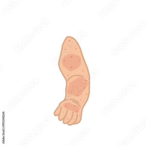 Vector illustration of measles. Body affected by measles. Illustration of hand, feet, face affected by measles. Flat design of measles virus