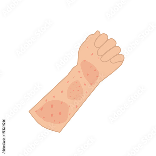 Vector illustration of measles. Body affected by measles. Illustration of hand, feet, face affected by measles. Flat design of measles virus