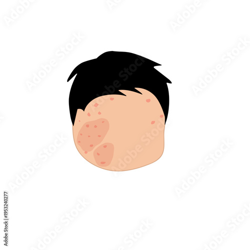Vector illustration of measles. Body affected by measles. Illustration of hand, feet, face affected by measles. Flat design of measles virus