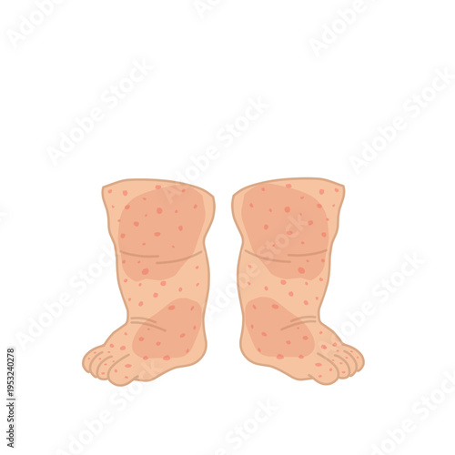 Vector illustration of measles. Body affected by measles. Illustration of hand, feet, face affected by measles. Flat design of measles virus