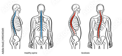 Scoliosis spine deformity