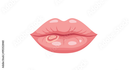 A cartoon illustration shows pink lips with a visible cold sore on the lower lip against a plain white background.