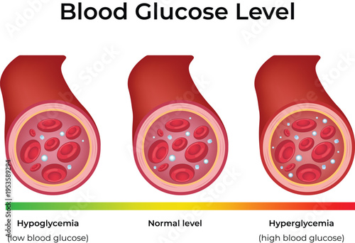 Blood Glucose Level Illustration with Hypoglycemia, Normal, and Hyperglycemia