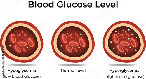 Blood Glucose Level Illustration with Hypoglycemia, Normal, and Hyperglycemia