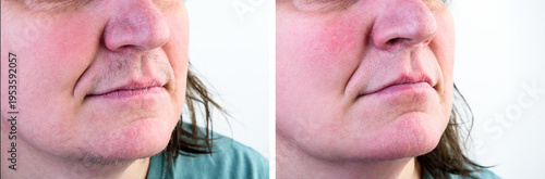 Woman's face with moustache and hairs on chin. Before and after hair removal and epilation.