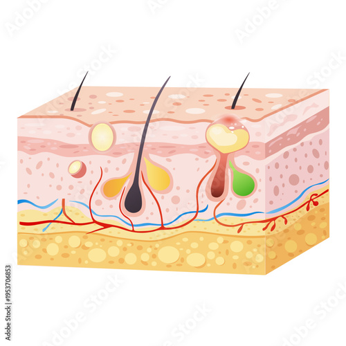 Acne skin structure. Pimple formation and inflammation diagram vector illustration