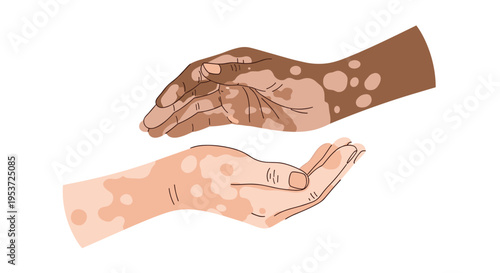 Two hands with vitiligo, one with darker skin and one with lighter skin, gently reaching towards each other to show support.