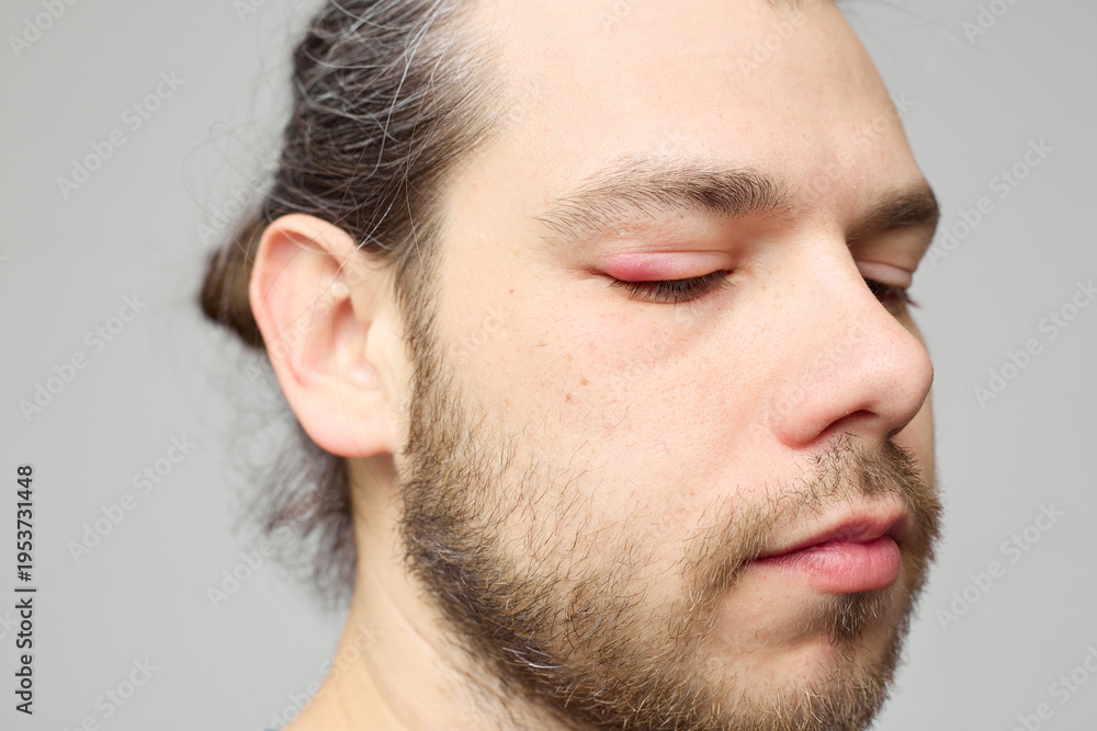 Obraz premium Swollen red eyelid close-up, eye inflammation or stye, medical condition