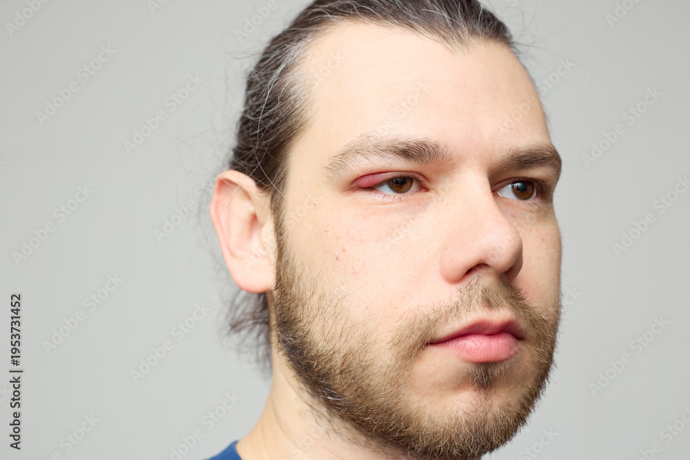 Obraz premium Swollen red eyelid close-up, eye inflammation or stye, medical condition